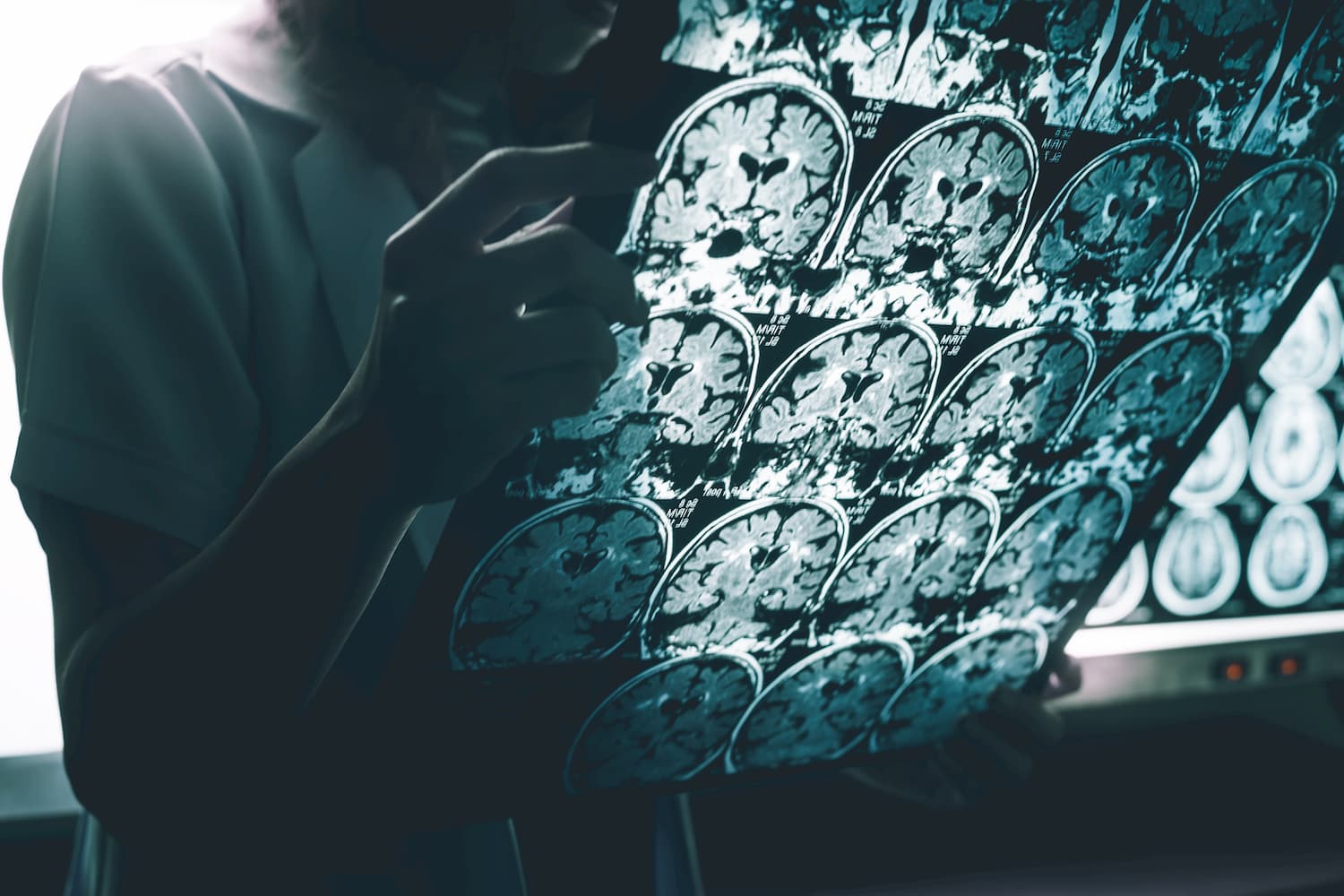recherche alzheimer